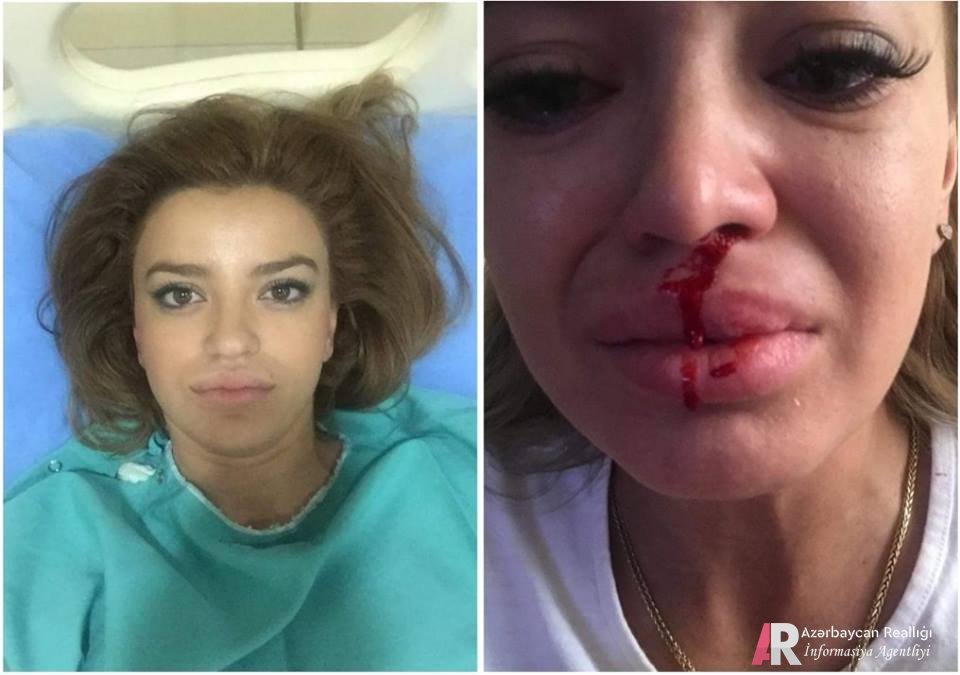 MedEra Hospitalda burun-dodaq əməliyyatı etdirən xanımı bu vəziyyətə saldılar: "Burnumdan qan gəlir, çirk gəlir, nəfəs ala bilmirəm" - FOTOLAR